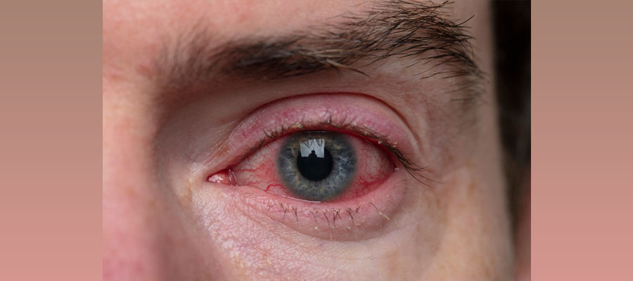 باید خشکی چشم را جدی بگیریم؟